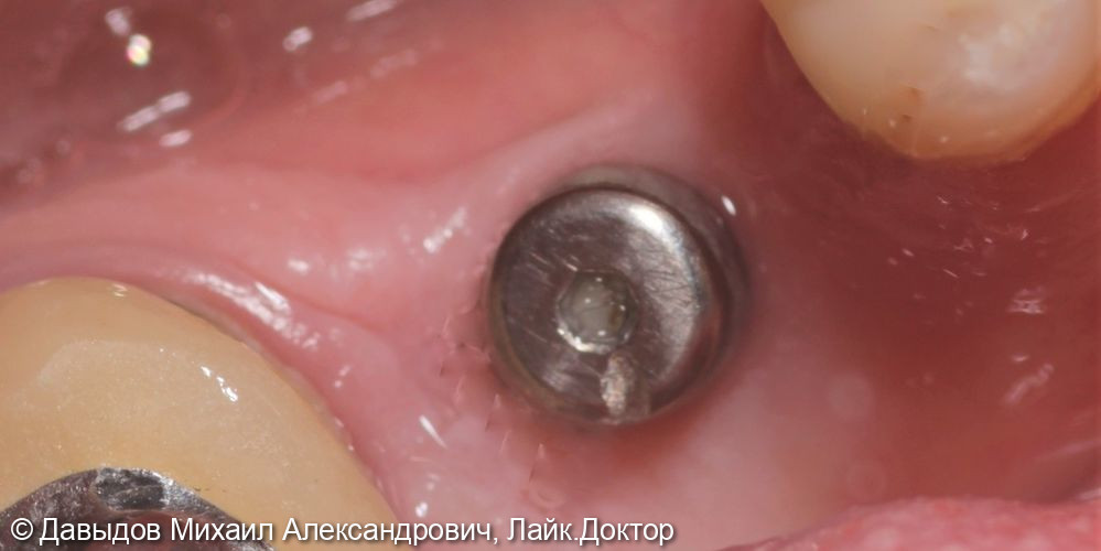 Протезирование зуба 46 металлокерамической коронкой c винтовой фиксацией на импланте Neobiotech - фото №1