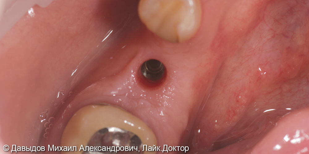 Протезирование зуба 46 металлокерамической коронкой c винтовой фиксацией на импланте Neobiotech - фото №2