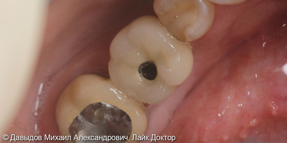 Протезирование зуба 46 металлокерамической коронкой c винтовой фиксацией на импланте Neobiotech - фото №3