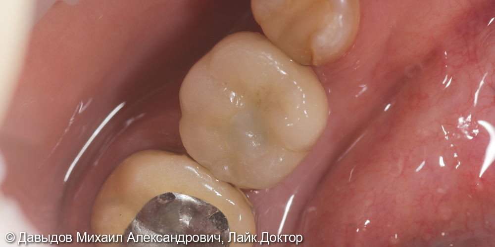 Протезирование зуба 46 металлокерамической коронкой c винтовой фиксацией на импланте Neobiotech - фото №4