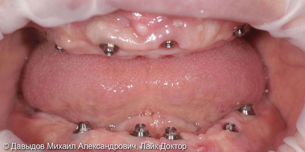 Тотальное протезирование верхних и нижних зубов металлокомпозитными протезами на имплантах - фото №1