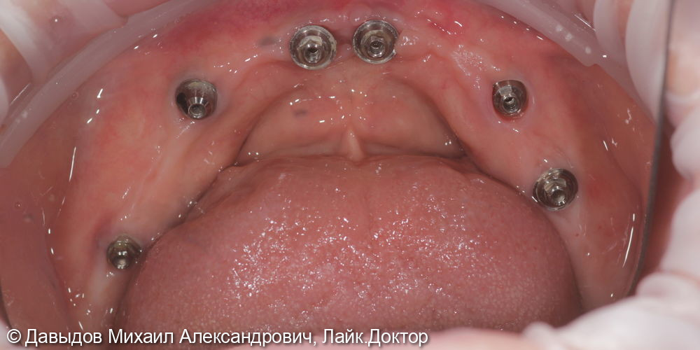 Тотальное протезирование верхних и нижних зубов металлокомпозитными протезами на имплантах - фото №3