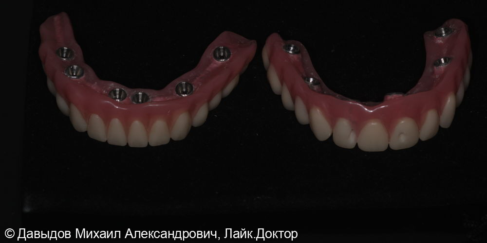 Тотальное протезирование верхних и нижних зубов металлокомпозитными протезами на имплантах - фото №4