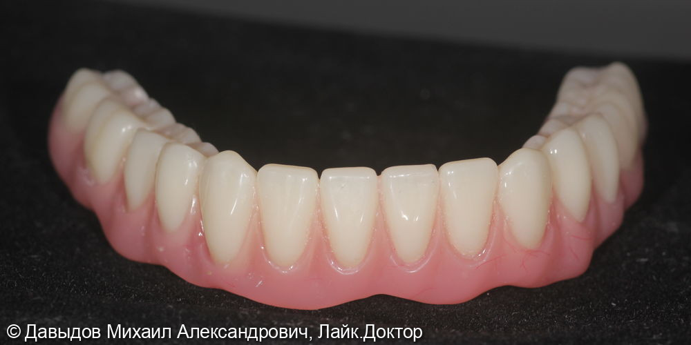 Тотальное протезирование верхних и нижних зубов металлокомпозитными протезами на имплантах - фото №5