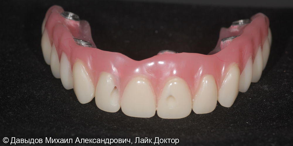 Тотальное протезирование верхних и нижних зубов металлокомпозитными протезами на имплантах - фото №6