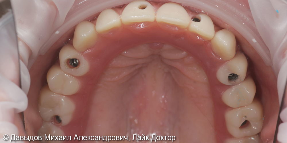 Тотальное протезирование верхних и нижних зубов металлокомпозитными протезами на имплантах - фото №7