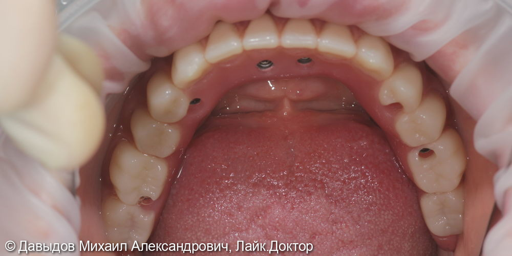Тотальное протезирование верхних и нижних зубов металлокомпозитными протезами на имплантах - фото №8