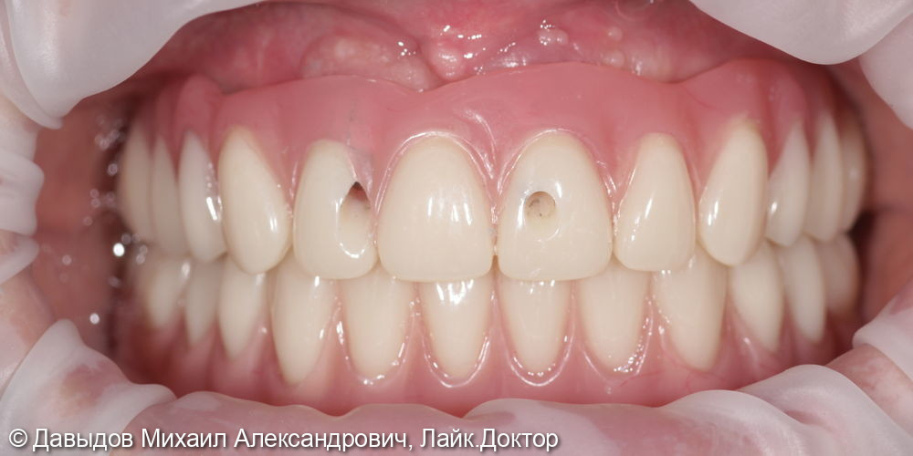 Тотальное протезирование верхних и нижних зубов металлокомпозитными протезами на имплантах - фото №9