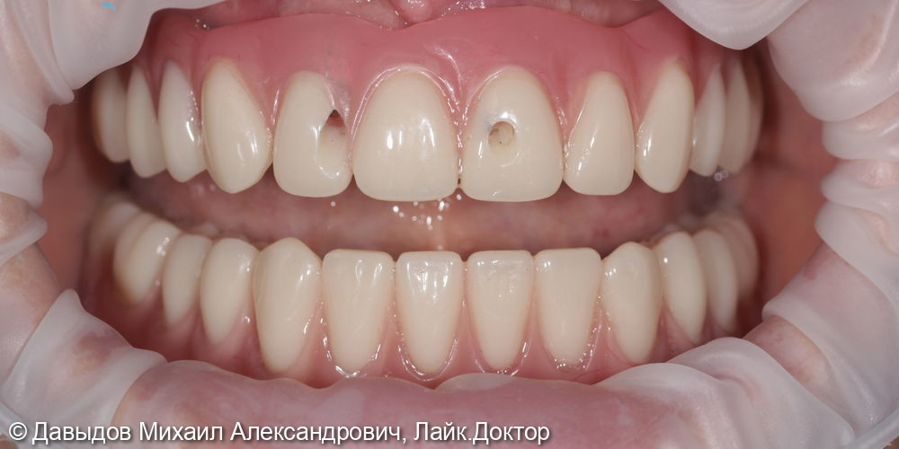 Тотальное протезирование верхних и нижних зубов металлокомпозитными протезами на имплантах - фото №10
