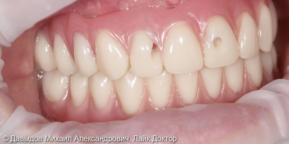Тотальное протезирование верхних и нижних зубов металлокомпозитными протезами на имплантах - фото №11