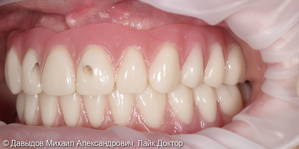 Тотальное протезирование верхних и нижних зубов металлокомпозитными протезами на имплантах - фото №12