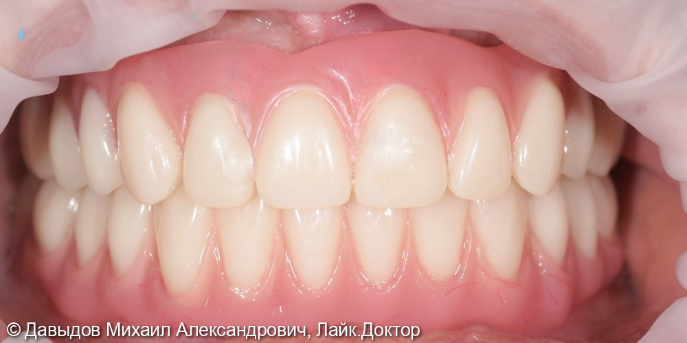 Тотальное протезирование верхних и нижних зубов металлокомпозитными протезами на имплантах - фото №13