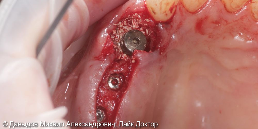 Протезирование жевательного отдела верхней и нижней челюсти металлокерамическими коронками на имплантах с винтовой фиксацией - фото №3