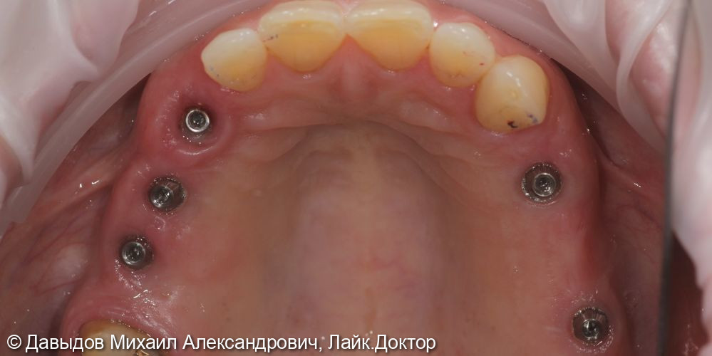 Протезирование жевательного отдела верхней и нижней челюсти металлокерамическими коронками на имплантах с винтовой фиксацией - фото №6