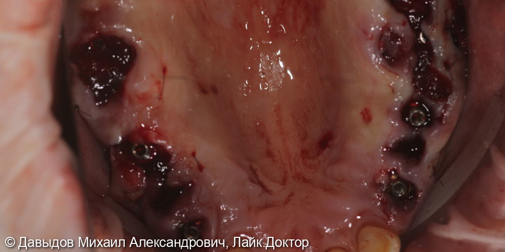 Протезирование боковых отделов верхней челюсти коронками из диоксида циркония на имплантах - фото №2