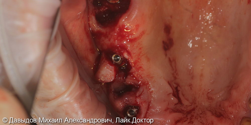 Протезирование боковых отделов верхней челюсти коронками из диоксида циркония на имплантах - фото №4