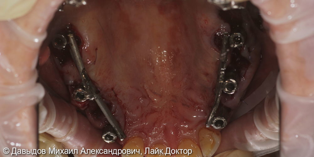 Протезирование боковых отделов верхней челюсти коронками из диоксида циркония на имплантах - фото №5