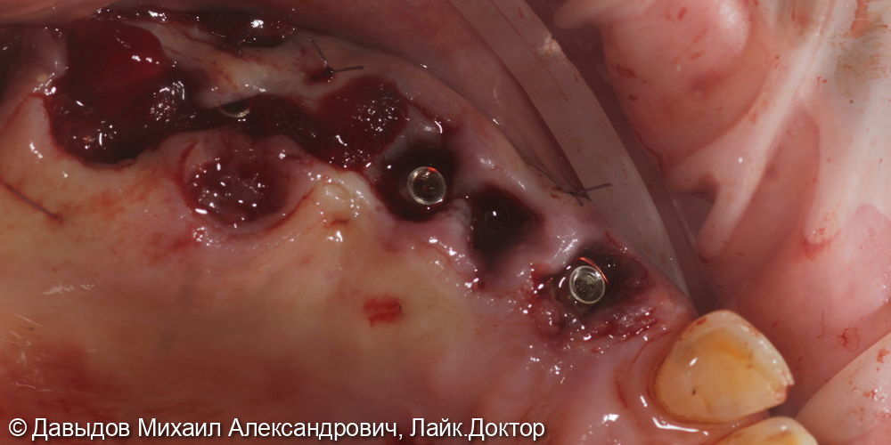 Протезирование боковых отделов верхней челюсти коронками из диоксида циркония на имплантах - фото №6