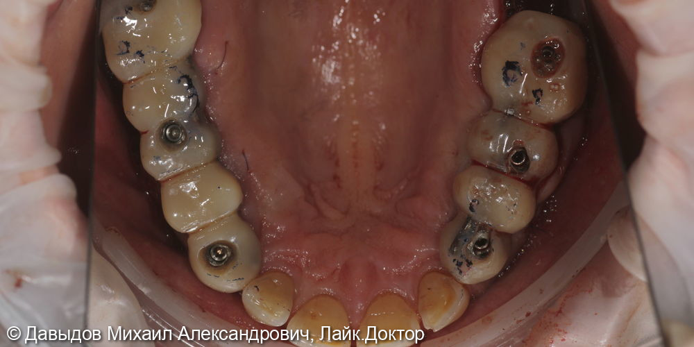 Протезирование боковых отделов верхней челюсти коронками из диоксида циркония на имплантах - фото №7