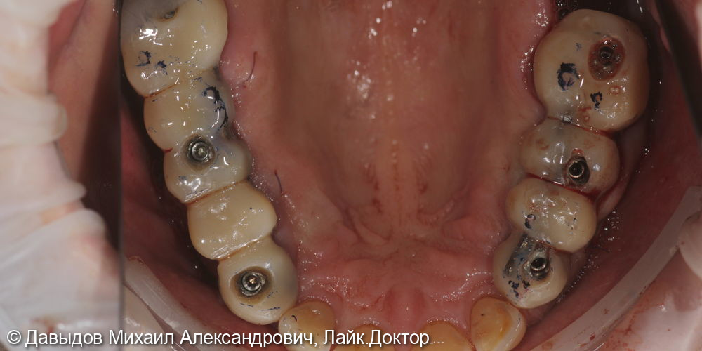 Протезирование боковых отделов верхней челюсти коронками из диоксида циркония на имплантах - фото №8