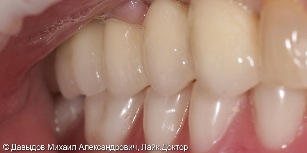 Протезирование боковых отделов верхней челюсти коронками из диоксида циркония на имплантах - фото №11