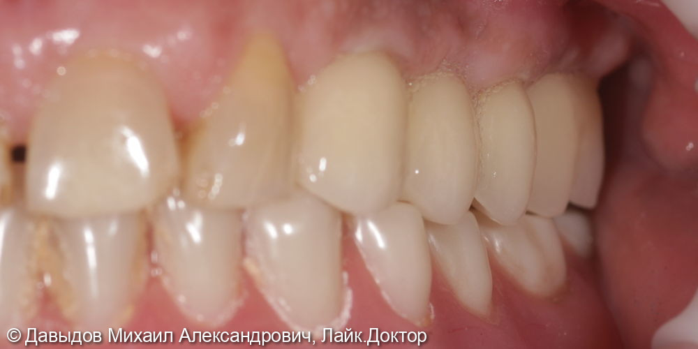 Протезирование боковых отделов верхней челюсти коронками из диоксида циркония на имплантах - фото №12