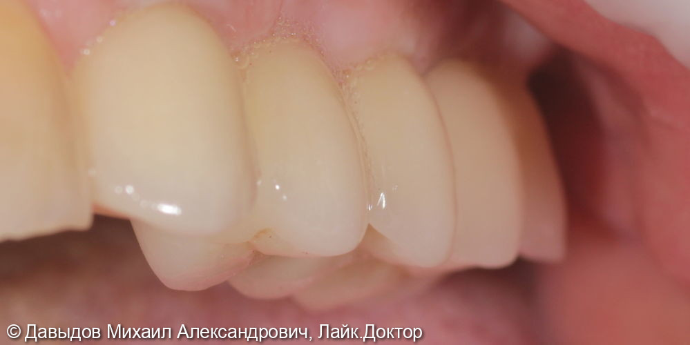 Протезирование боковых отделов верхней челюсти коронками из диоксида циркония на имплантах - фото №14