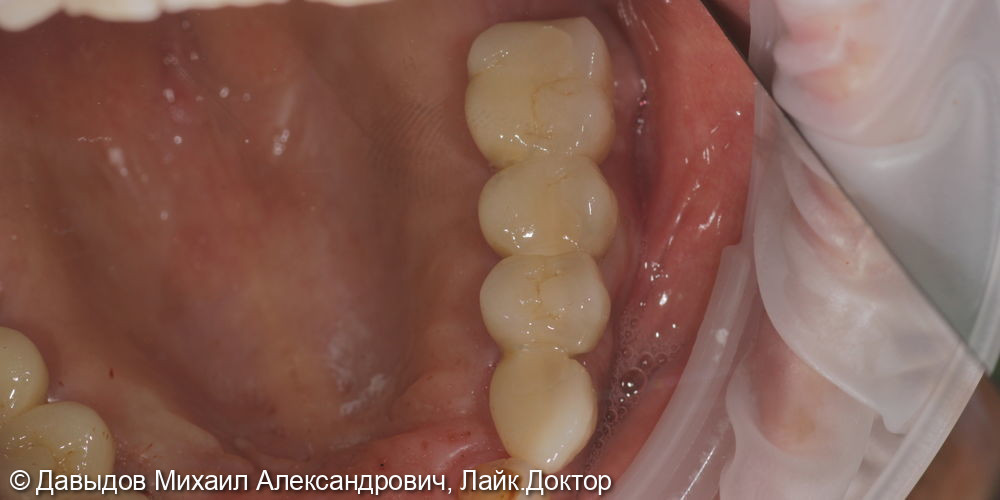 Протезирование боковых отделов верхней челюсти коронками из диоксида циркония на имплантах - фото №16
