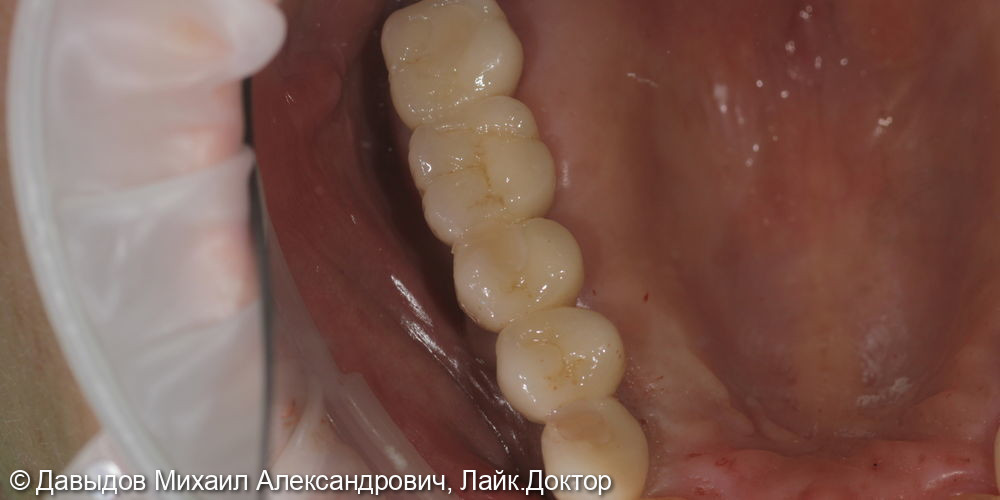 Протезирование боковых отделов верхней челюсти коронками из диоксида циркония на имплантах - фото №17