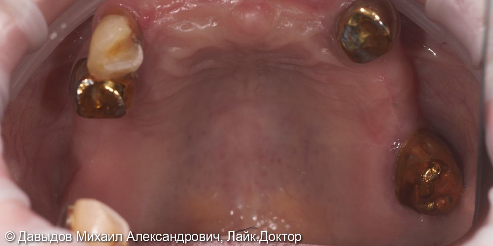 Протезирование зубов верхней и нижней челюсти на имплантах мостовидными металлокомпозитными протезами - фото №1