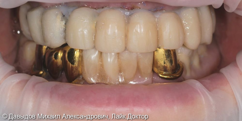 Протезирование зубов верхней и нижней челюсти на имплантах мостовидными металлокомпозитными протезами - фото №2