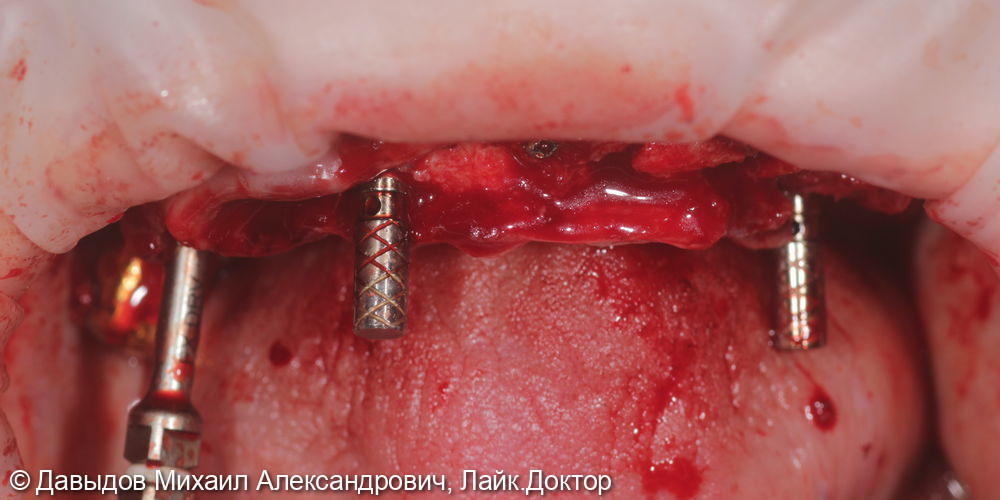 Протезирование зубов верхней и нижней челюсти на имплантах мостовидными металлокомпозитными протезами - фото №3