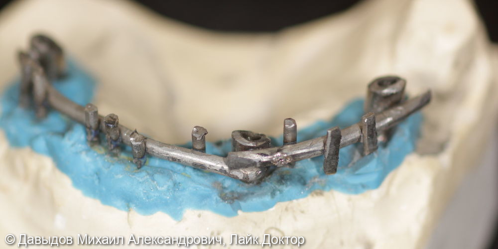 Протезирование зубов верхней и нижней челюсти на имплантах мостовидными металлокомпозитными протезами - фото №5