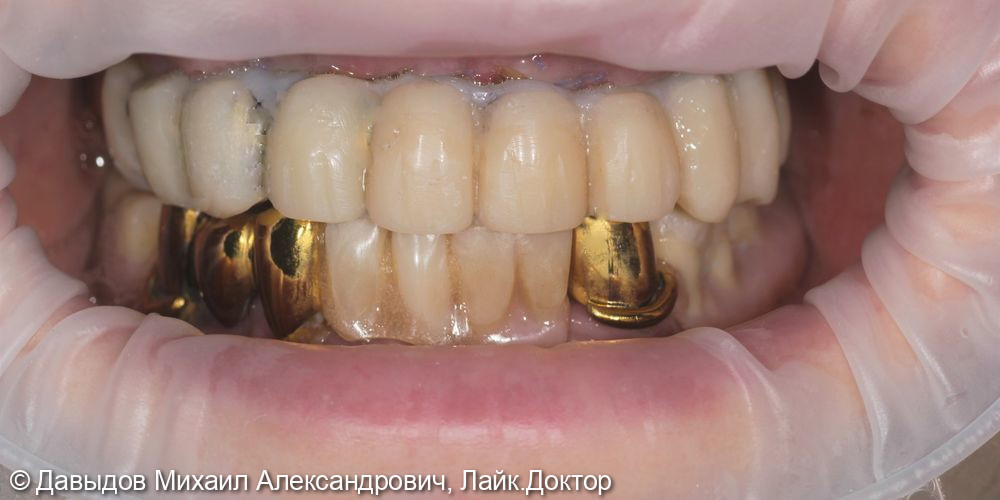 Протезирование зубов верхней и нижней челюсти на имплантах мостовидными металлокомпозитными протезами - фото №7