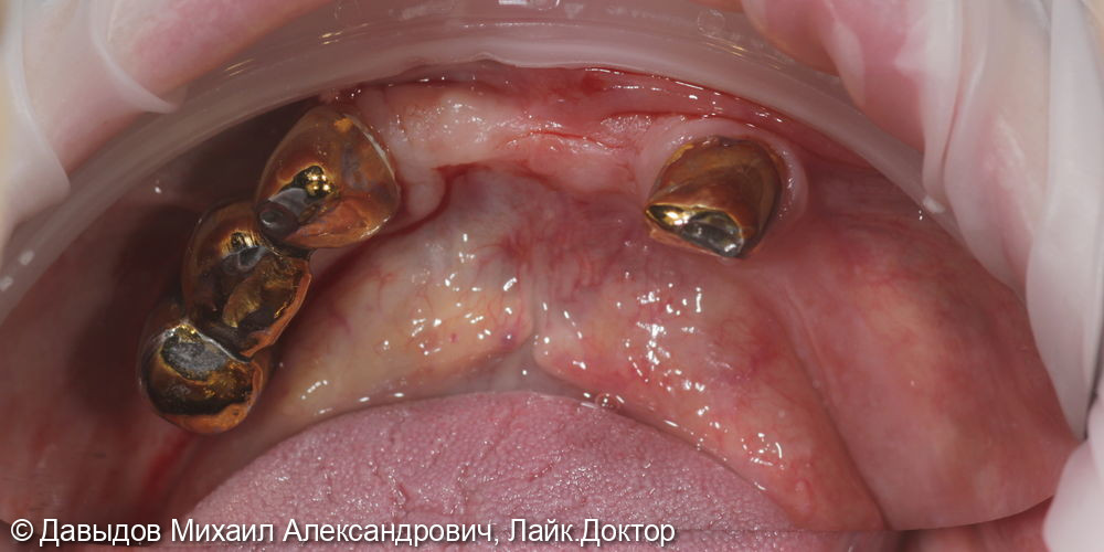 Протезирование зубов верхней и нижней челюсти на имплантах мостовидными металлокомпозитными протезами - фото №8