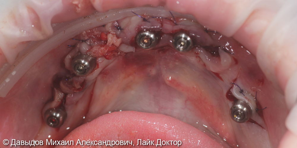 Протезирование зубов верхней и нижней челюсти на имплантах мостовидными металлокомпозитными протезами - фото №9