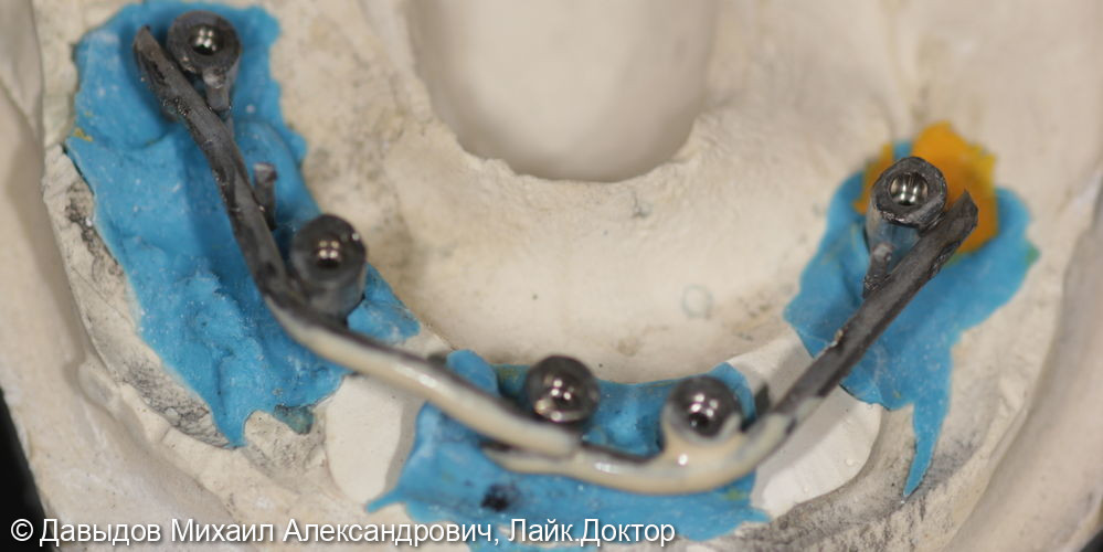 Протезирование зубов верхней и нижней челюсти на имплантах мостовидными металлокомпозитными протезами - фото №10