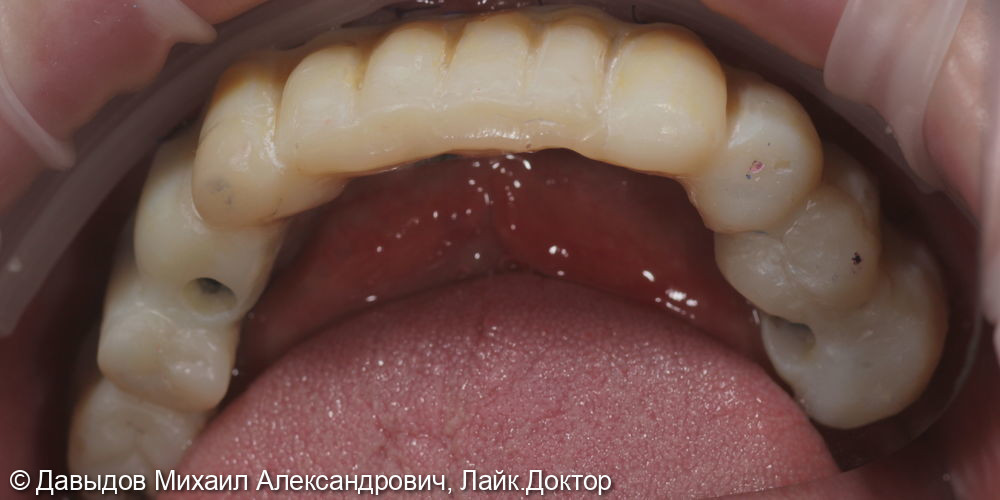 Протезирование зубов верхней и нижней челюсти на имплантах мостовидными металлокомпозитными протезами - фото №11