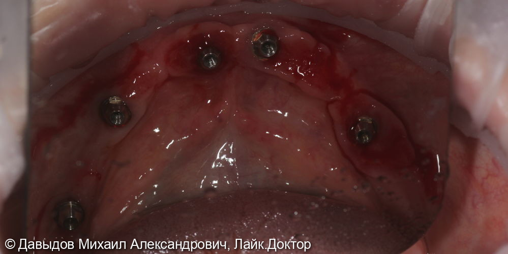 Протезирование зубов верхней и нижней челюсти на имплантах мостовидными металлокомпозитными протезами - фото №12