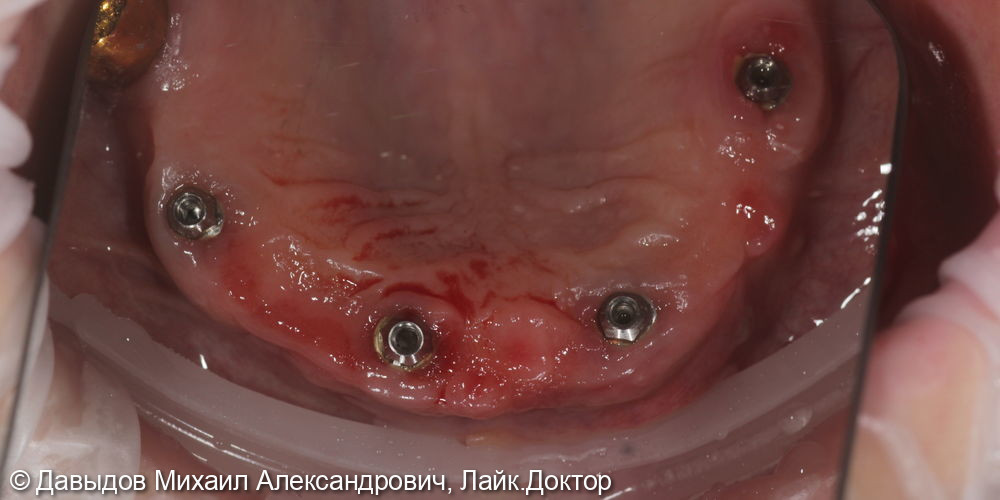 Протезирование зубов верхней и нижней челюсти на имплантах мостовидными металлокомпозитными протезами - фото №13