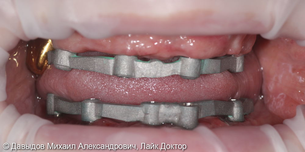 Протезирование зубов верхней и нижней челюсти на имплантах мостовидными металлокомпозитными протезами - фото №14
