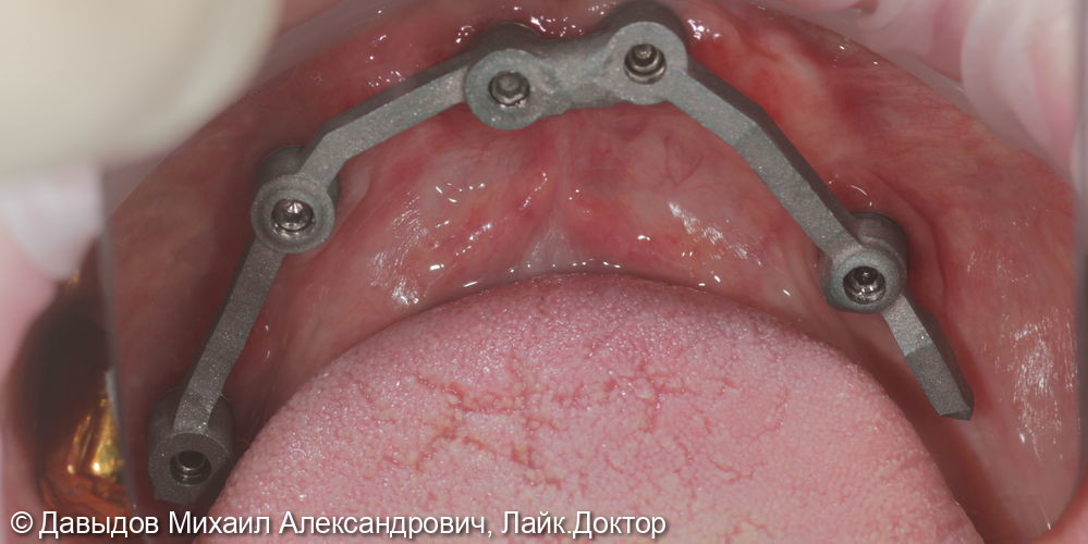 Протезирование зубов верхней и нижней челюсти на имплантах мостовидными металлокомпозитными протезами - фото №15