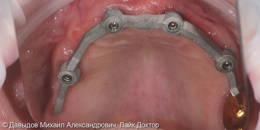 Протезирование зубов верхней и нижней челюсти на имплантах мостовидными металлокомпозитными протезами - фото №16
