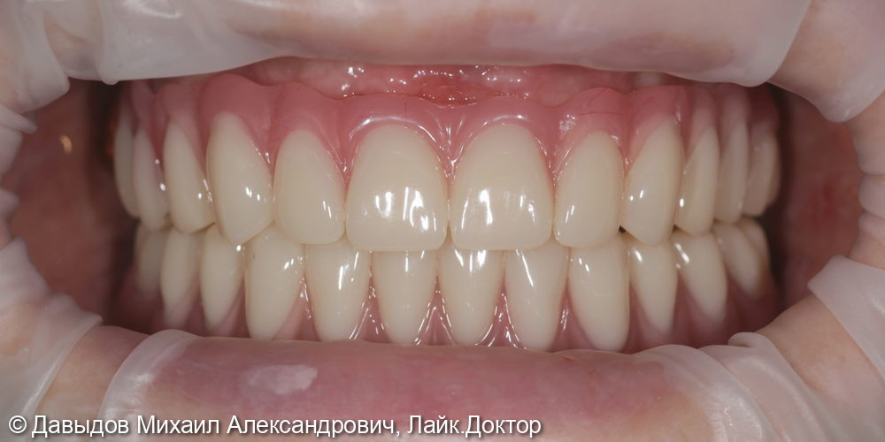 Протезирование зубов верхней и нижней челюсти на имплантах мостовидными металлокомпозитными протезами - фото №18