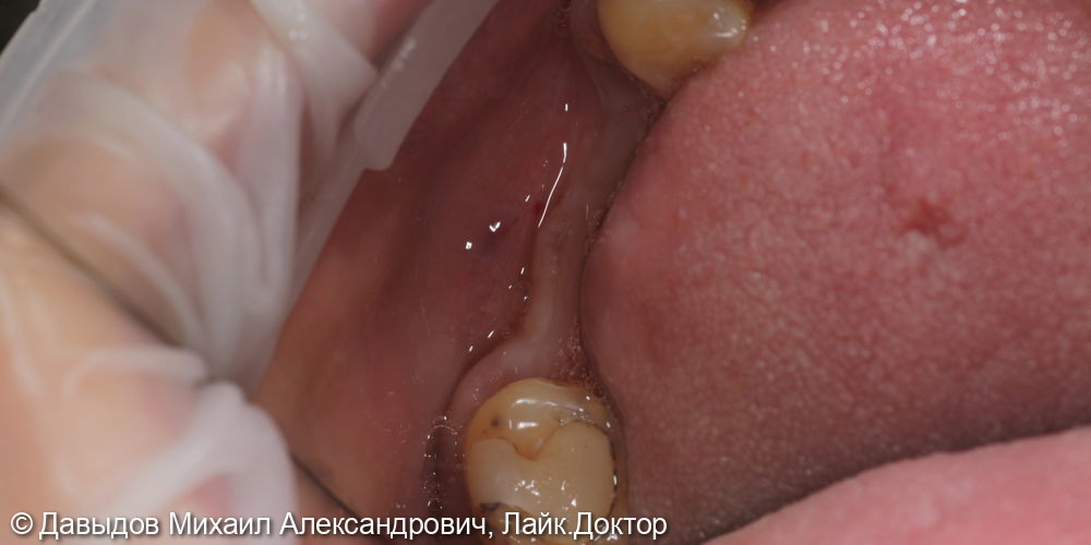 Имплантация в области зубов 46,47 с установкой мульти-юнитов с защитными колпачками - фото №1