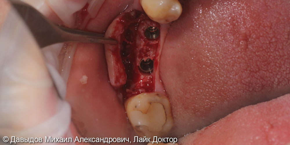 Имплантация в области зубов 46,47 с установкой мульти-юнитов с защитными колпачками - фото №2