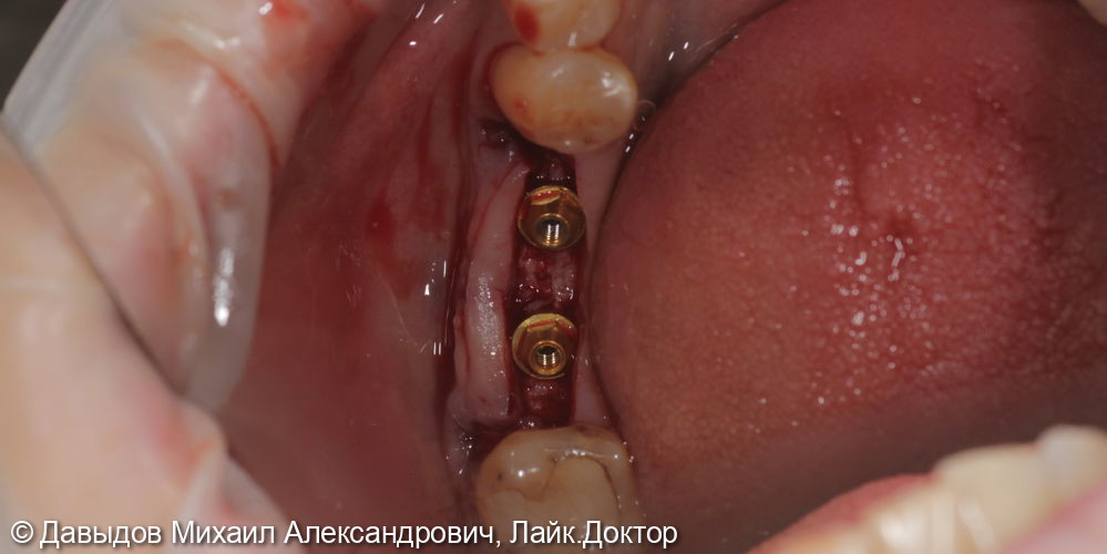 Имплантация в области зубов 46,47 с установкой мульти-юнитов с защитными колпачками - фото №3