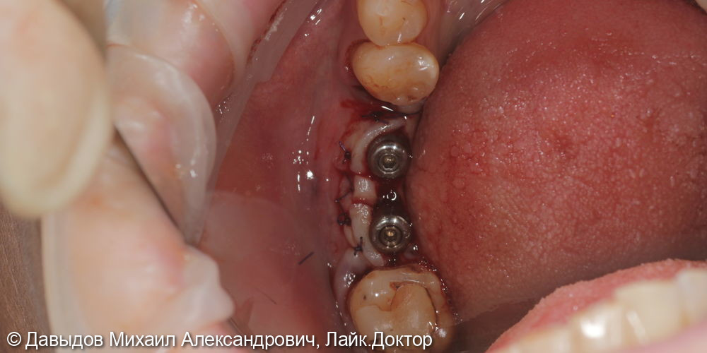 Имплантация в области зубов 46,47 с установкой мульти-юнитов с защитными колпачками - фото №4