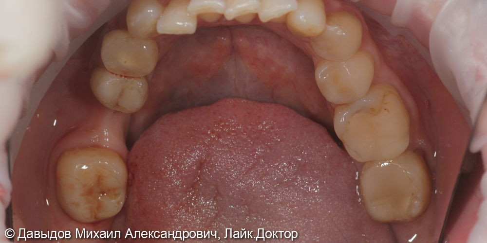 Удаление ретинированного зуба мудрости, удаление зуба 44 с одномоментной имплантацией, установка импланта 46 - фото №1
