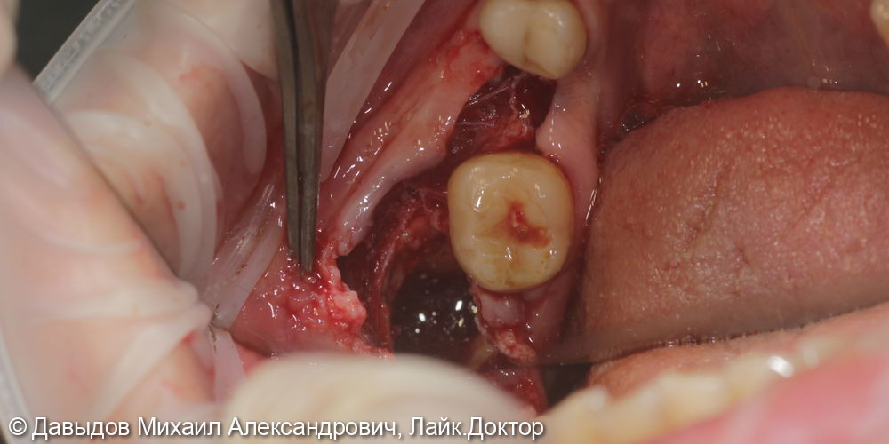 Удаление ретинированного зуба мудрости, удаление зуба 44 с одномоментной имплантацией, установка импланта 46 - фото №4